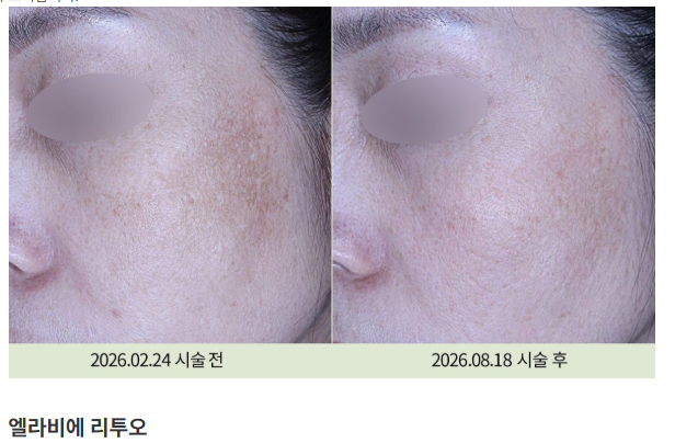 리쥬란힐러·리투오·쥬베룩 관련 치료 사진